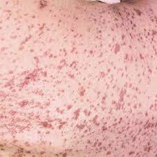 Although progress has been made in the management of sjs through. Typical Pattern Of Stevens Johnson Syndrome Blisters Develop On Download Scientific Diagram