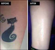 Scar Skin Color Tattoo Skin Color Tattoo Cover Scar Near Me