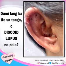 The photosensitivity of sle — mechanisms: Ano Ang Lupus O Systemic Dr Geraldine Ging Zamora Facebook