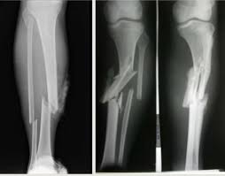 Fractura De Tibia Y Perone Consultas Y Experiencias