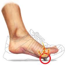 Image result for Metatarsalgia