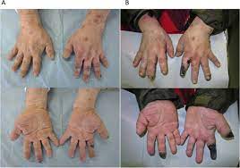 Necrosis is the death of body tissue. Finger Necrosis With Eosinophilia And Symmetrical Occlusion Of The Peripheral Artery Heart Asia