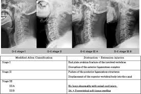 Image result for Subaxial Injury Classification Scale