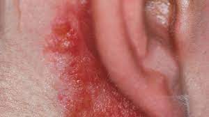 The pathogen may reach the skin by exogenous inoculation, via the blood or lymph from a tuberculous internal organ, or by direct extension from underlying infected glands or joints. Tuberculosis Cutis Luposa Altmeyers Enzyklopadie Fachbereich Dermatologie