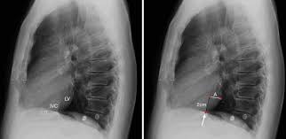 Image result for Hoffman Sign