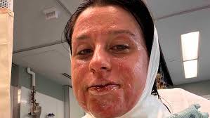 Fundraiser for Hannah Mcguckin by Mercedes Slaughterbeck : Support Hannah's  Burn Recovery Journey