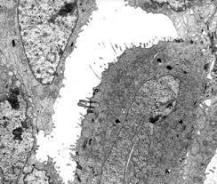 But was present on microscopy of the lungs at necropsyin six cases. The Diagnostic Utility Of Immunohistochemistry And Electron Microscopy In Distinguishing Between Peritoneal Mesotheliomas And Serous Carcinomas A Comparative Study Modern Pathology