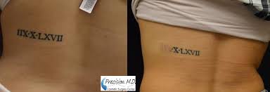 Laser treatments work best on dark colors, such as black, purple, blue, and red. Tattoo Removal Sacramento Laser Tattoo Removal Sacramento Tattoo Removal Laser Tattoo Laser Tattoo Removal