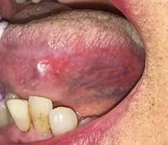 Oral cancer often starts as a tiny, unnoticed white or red spot or sore anywhere in the mouth. Know Your Leukoplakias To Identify Oral Cancer Dentistry Today