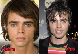 Reid Ewing Plastic Surgery Before And After Celebrity Plastic Surgery Reid Ewing Plastic Surgery