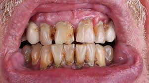 Some target specific social groups, so it's important to check what kind of candidates they are looking for. Meth Mouth What Is Meth Mouth Effects Symptoms Treatment