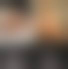 Image result for toe amputation