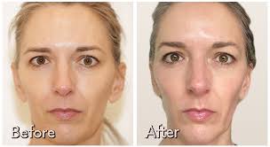 Morpheus8 results the results of tissue remodeling begin to appear within a few days of morpheus8 treatment. Morpheus8 Reviews Benefits Of The Skin Tightening Morpheus8 Nubo Beauty