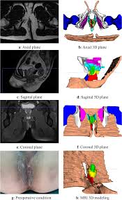 Image result for Ischiorectal Abscess