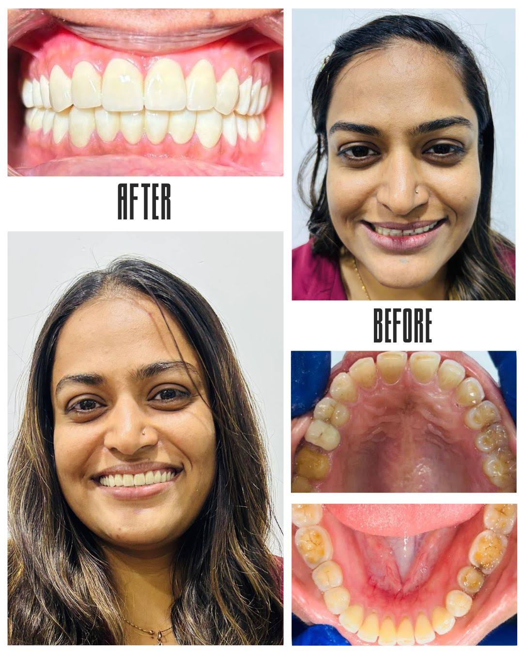 Full Mouth Rehabilitation product image