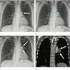 Ct scanning is used to assess the spread of the tumor (staging). 1