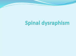 Image result for Spinal Dysraphism