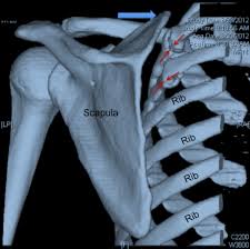 Image result for Scapulothoracic Injection