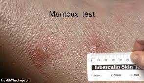 It is less than 100% sensitive and specific; Mantoux Skin Test Procedure Results Interpretation Risks