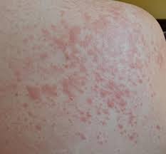 Image result for sweat rash on back