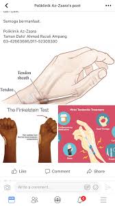 Dequervain S Tenosynovitis Sakit Pergelangan Tangan Wanita Selepas Bersalin