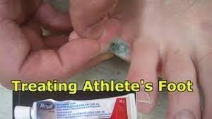 It feels a bit strange to do at first, but the moisture will be removed from the places on the foot where the fungus likes to grow and that lowers your risk of an infection. Athlete S Foot What Is It How To Treat It And How To Avoid It A Must Watch Youtube