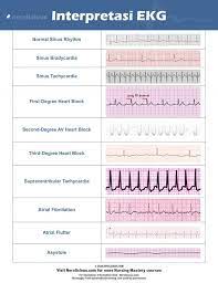 Bila sesuai dgn kriteria normal maka ekg tsb adalah. 7 Langkah Mudah Interpretasi Ekg Nerslicious Ekg Pr Interval Normal Sinus Rhythm