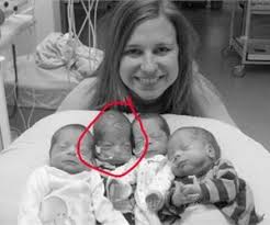 Black Babies Born White Then Turn Black Mom Gives Birth To Quadruplets Then Doctors Notice The Baby Quadruplets Varicose Vein Remedy Multiple Pregnancies