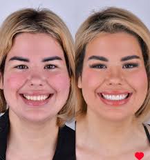 Teeth done with great results