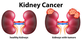When you get a diagnosis of kidney cancer, it's natural to wonder what may have caused the disease. Kidney Cancer Treatment Bangalore Renal Tumor Treatment Karnataka