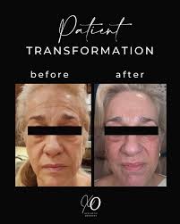 Wow!! 1 Medium-Depth CO2 Laser treatment & the implementation of a  customized skincare routine! 👏🏼 Transformation by  @spaceykasi.nurseinjector 💉 . 👩🏻‍⚕️ Jana Brewer