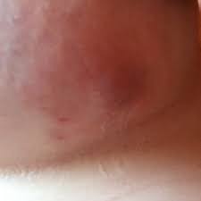 Blase Unter Der Brust Gesundheit Und Medizin Schmerzen Entzundung