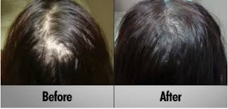 Hair Restore Biotin Hair Growth Serum Review Rapid Hair Growth Boosting Serum In 2020 Hair Regrowth New Hair Growth Biotin Hair