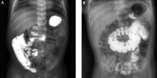 Image result for Midgut Volvulus