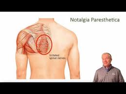Image result for Notalgia Paresthetica