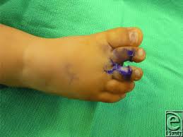 Image result for Syndactyly