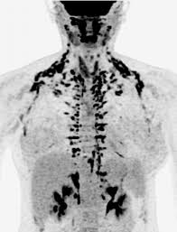 Brown adipose tissue (bat), or brown fat, is one of two types of fat. Drug Increases Brown Fat Activity In Healthy Women National Institutes Of Health Nih