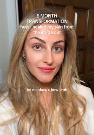 No Sugar Face Results 5 Months