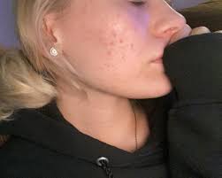 Can azelaic acid be used with benzoyl peroxide or salicylic acid?