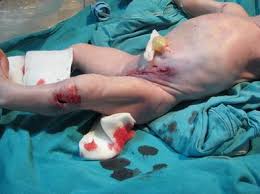 I think first it's important to understand what a graze wound is medically— which would be a skin injury without serious underlying injury. Gunshot Wound Of The Fetus Springerlink
