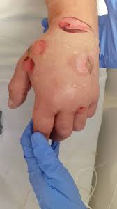 Bolnavii din secția ati sibiu. 72 6fvielatlqm