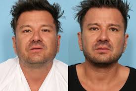 Inmode embracerf works best in mild and moderate conditions. Non Surgical Facelift With Embracerf El Paso Tx Frank Agullo Md