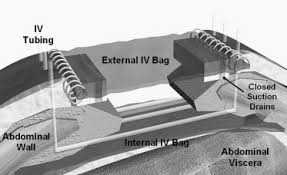 We did not find results for: Dynamic Retention Suture Closure Modified Bogota Bag Approach Journal Of Surgical Research