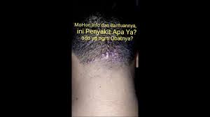 Gantungkan handuk di atas kepala dan arahkan kepala anda di atas air selama sekitar 10 menit. Bintik Bintik Jerawat Di Bagian Belakang Kepala 5 Tahun Belum Sembuh Youtube