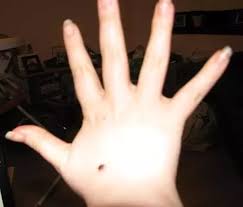 Having a blister on your hand is annoyingly painful. What Does A Black Mole Mean On The Right Hand Of A Female Quora