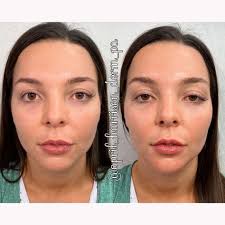 Wit volux results can last up to two years. Chin Jawline Filler