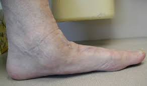 Maybe you would like to learn more about one of these? Posterior Tibial Tendon Dysfunction Pttd Narrabeen Sports And Exercise Medicine Centre