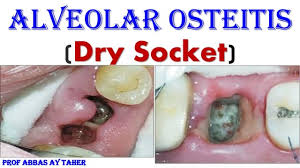 Image result for Alveolitis sicca)