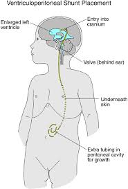 Examples include nerves in your child's skull, his pituitary gland, or the membranes that cover his brain. Oncology Brain Tumors Children S Wisconsin