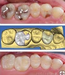 Pin By Berivan On Dentiste Dentistry Dental Aesthetics Dental Bridge